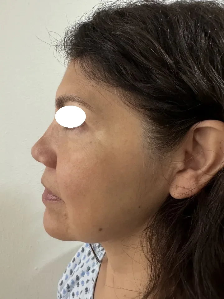 Antes de lifting facial deep plane