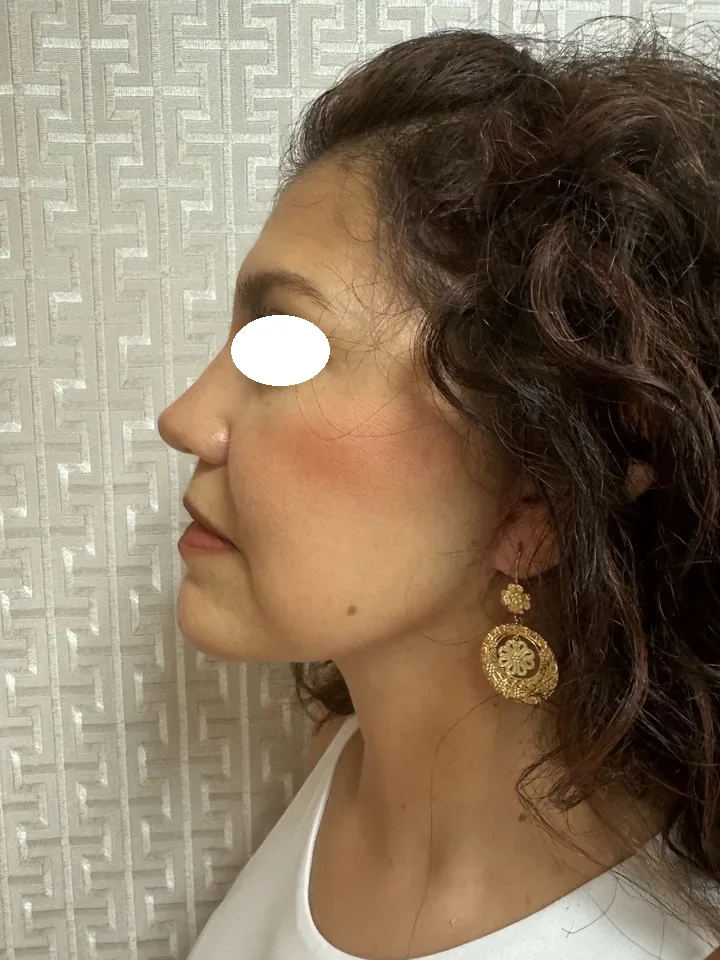 Después de lifting facial deep plane
