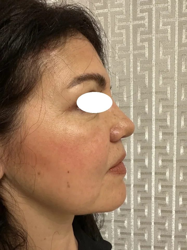 Antes de lifting facial deep plane