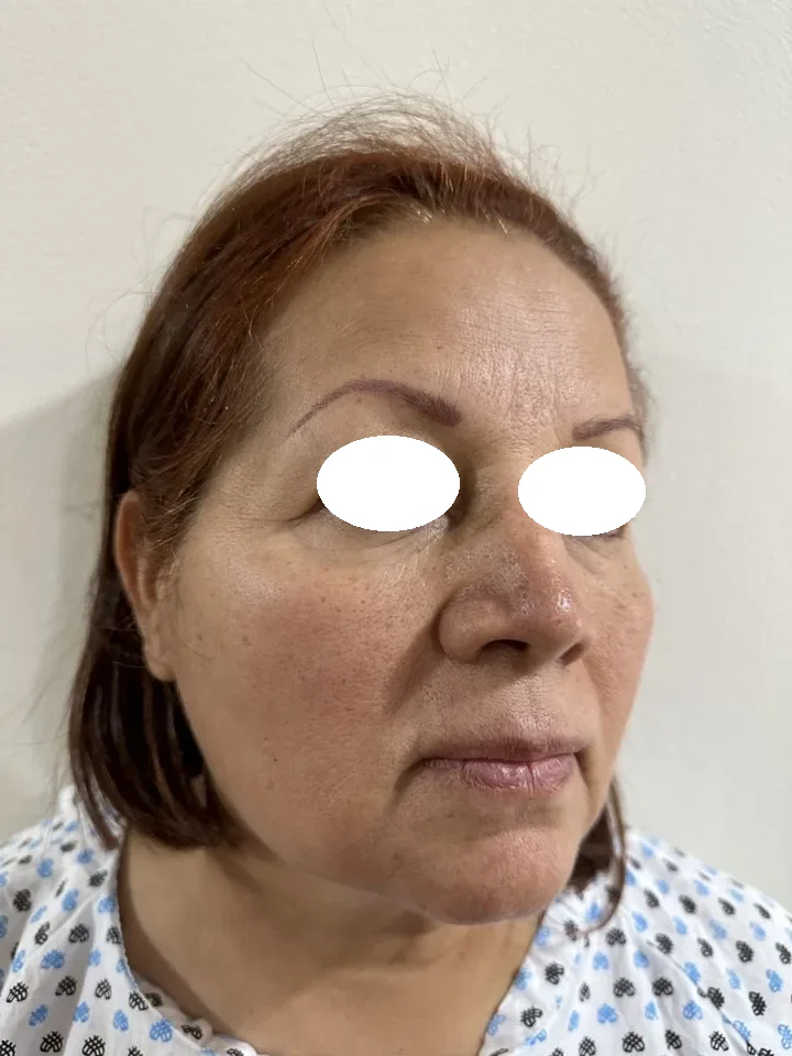 Antes de lifting facial deep plane