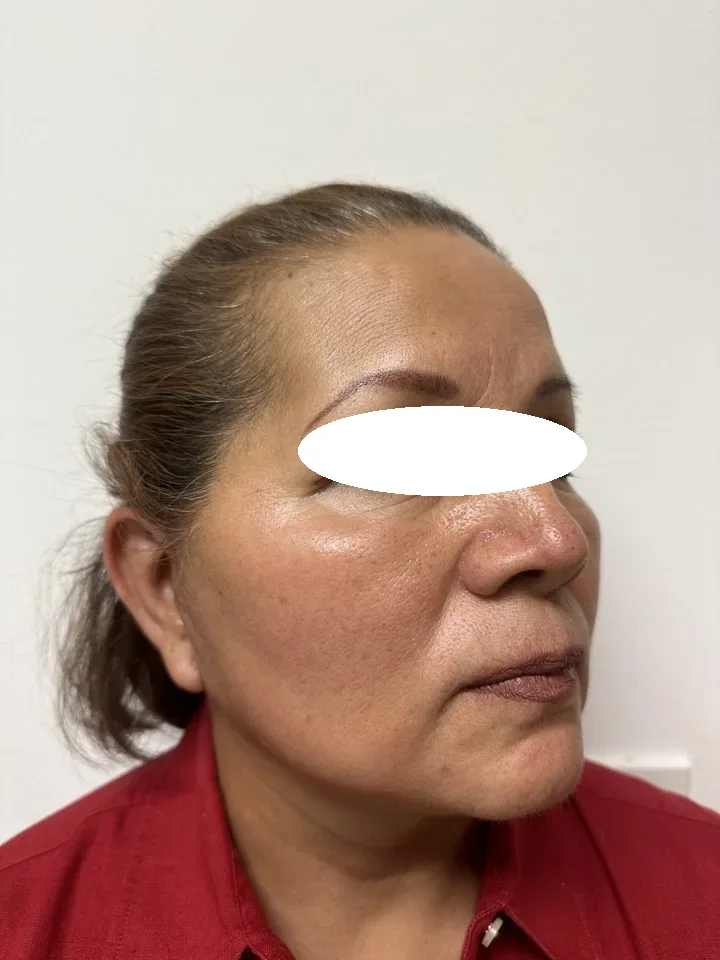Después de lifting facial deep plane