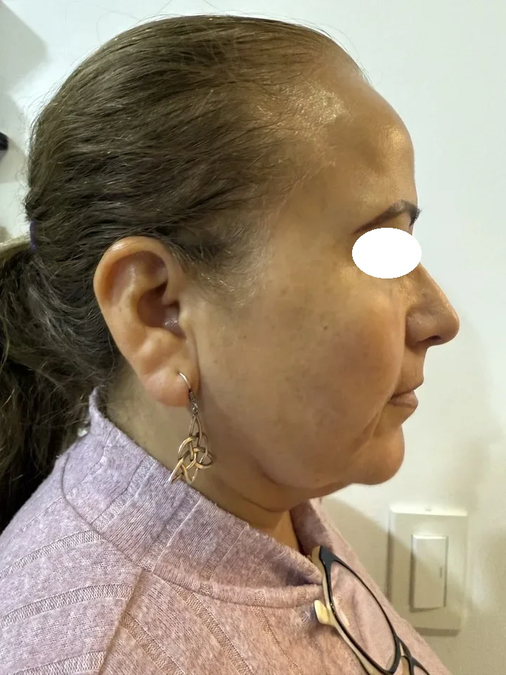 Antes de lifting facial deep plane