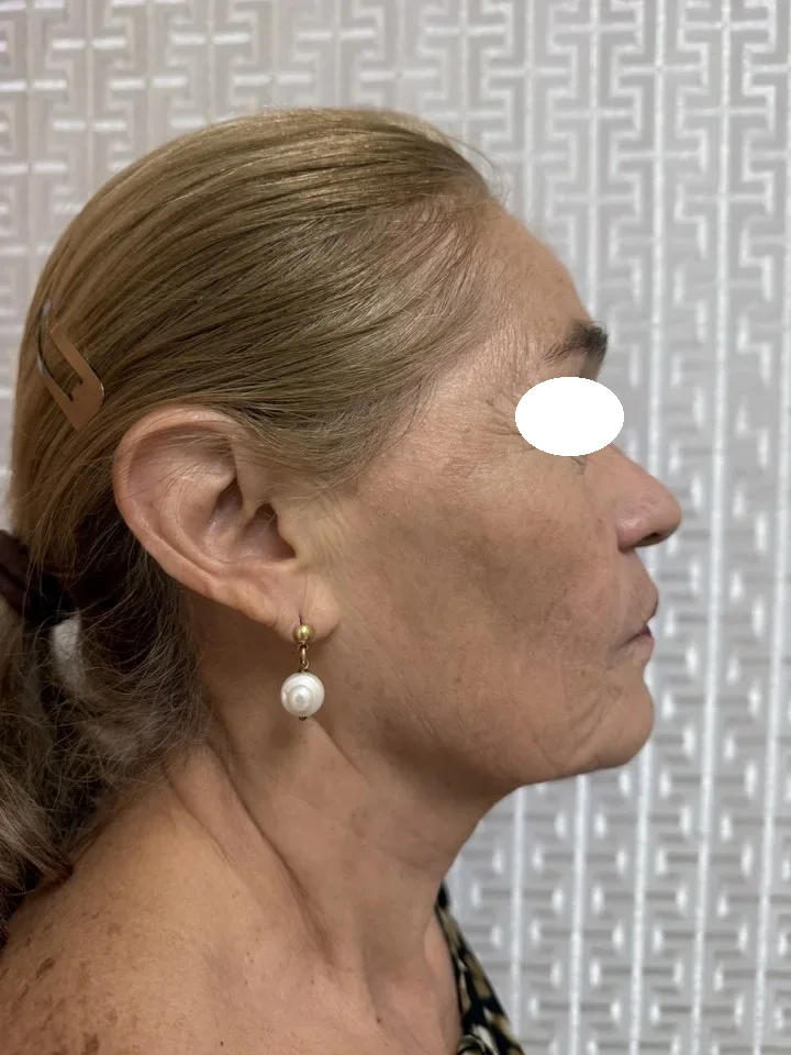 Antes de lifting facial deep plane