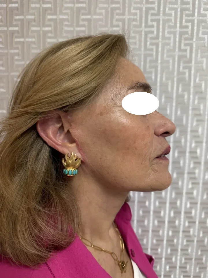 Después de lifting facial deep plane