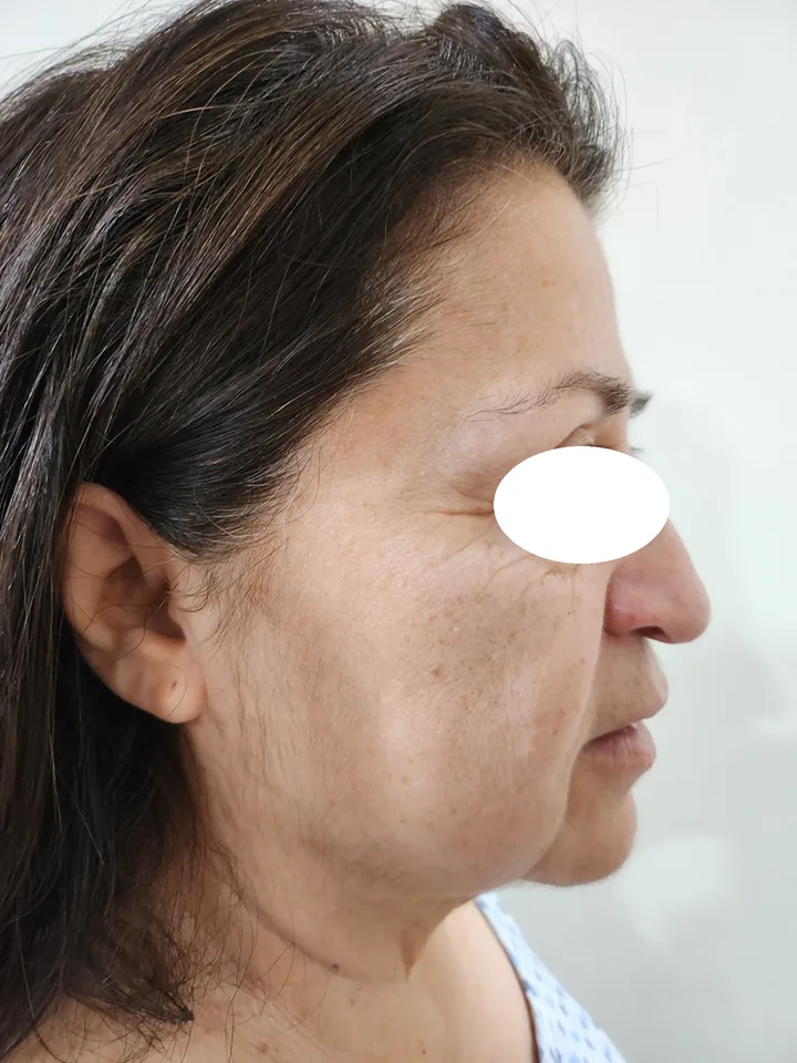 Antes, vista de perfil
