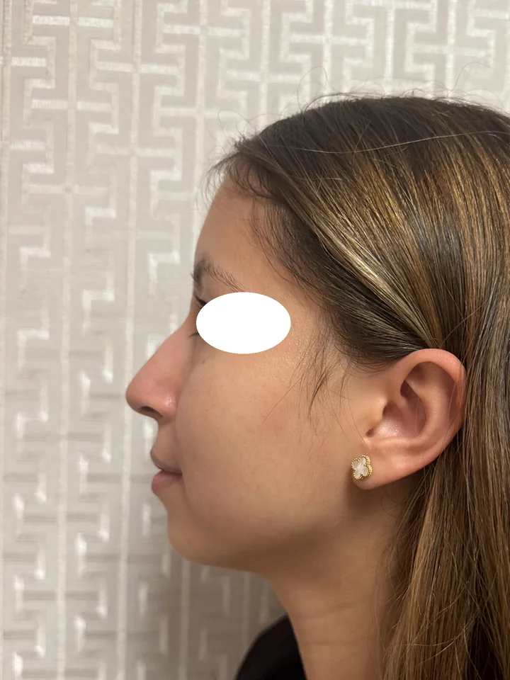 Antes, vista de perfil