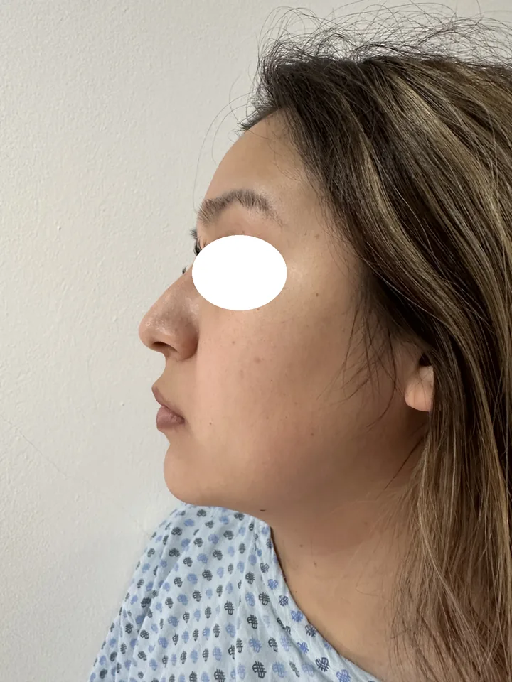 Antes, vista de perfil