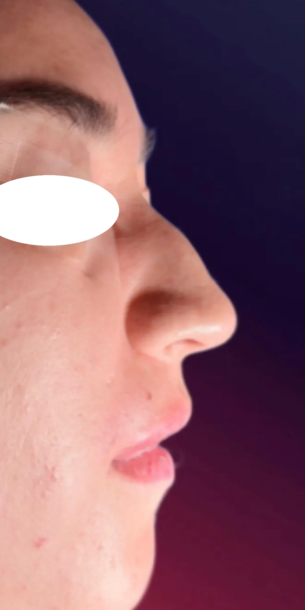 Antes de la rinoplastia, vista de perfil