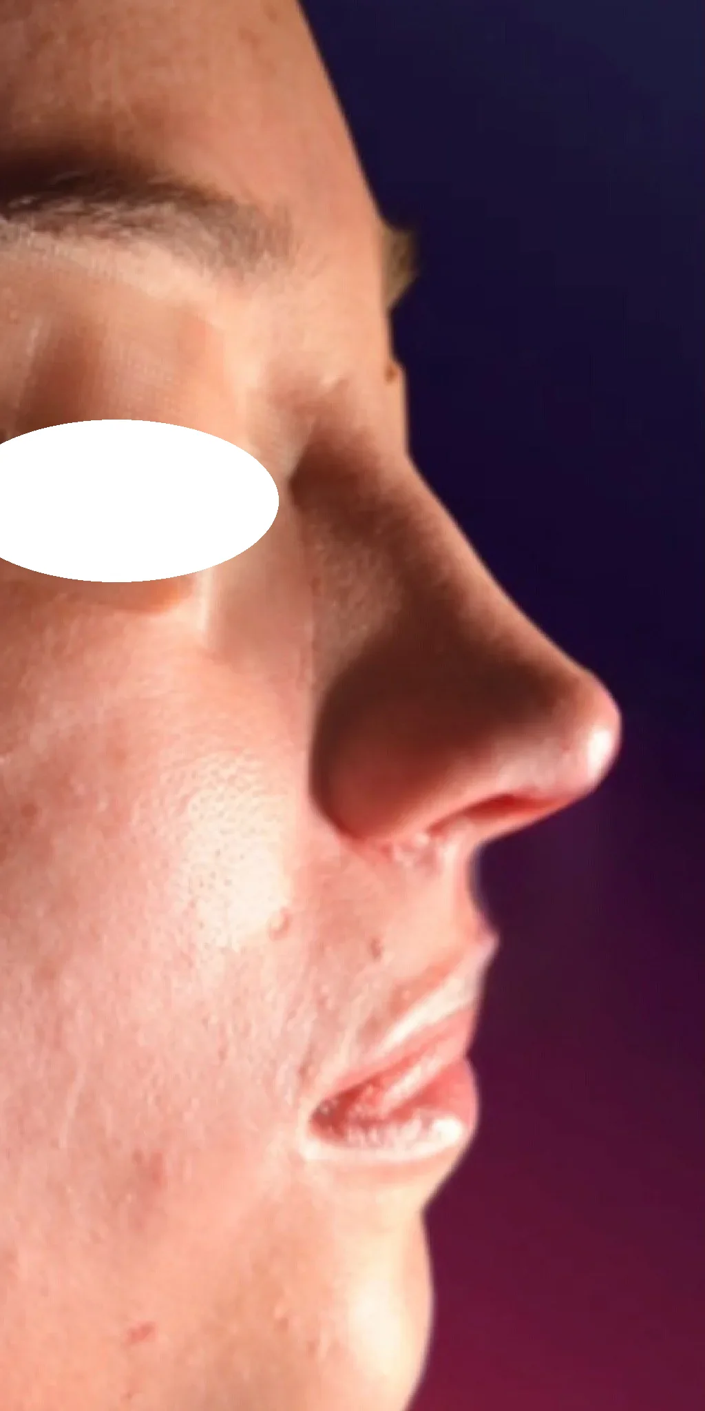 Después de la rinoplastia, vista de perfil