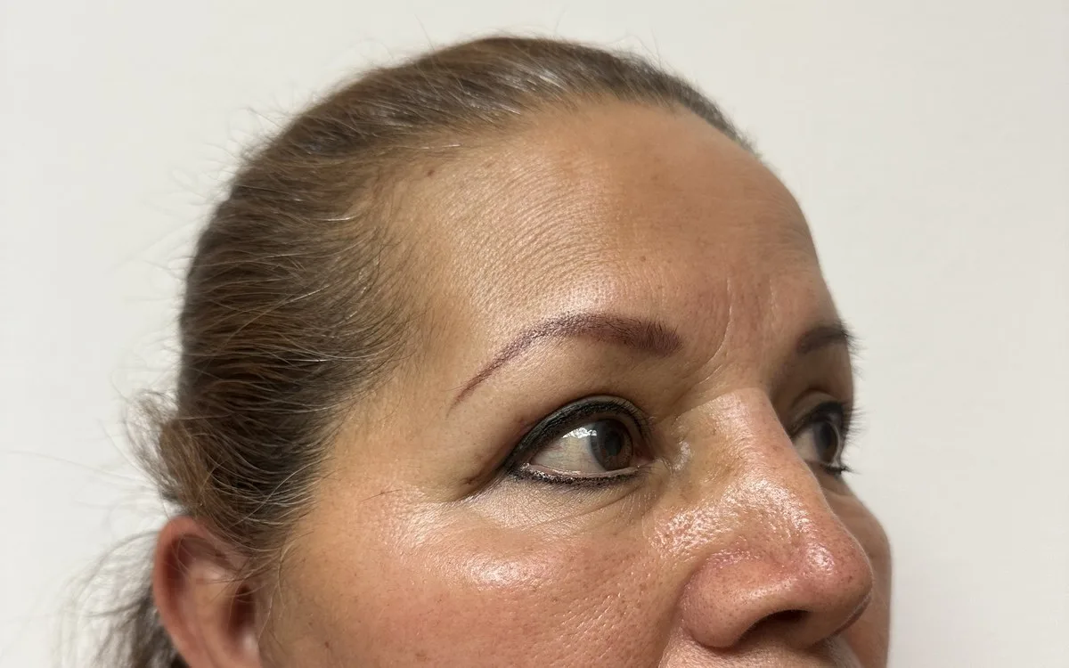 Resultado de blefaroplastia