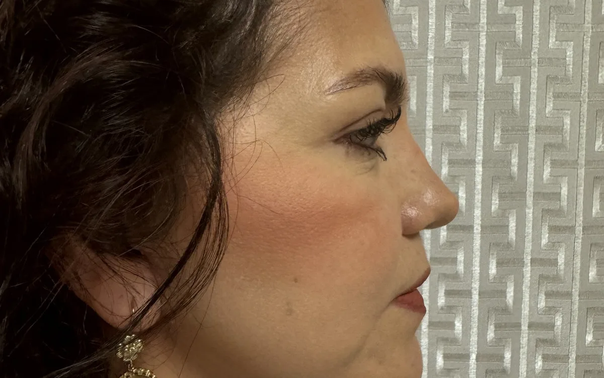 Resultado de lifting facial deep plane