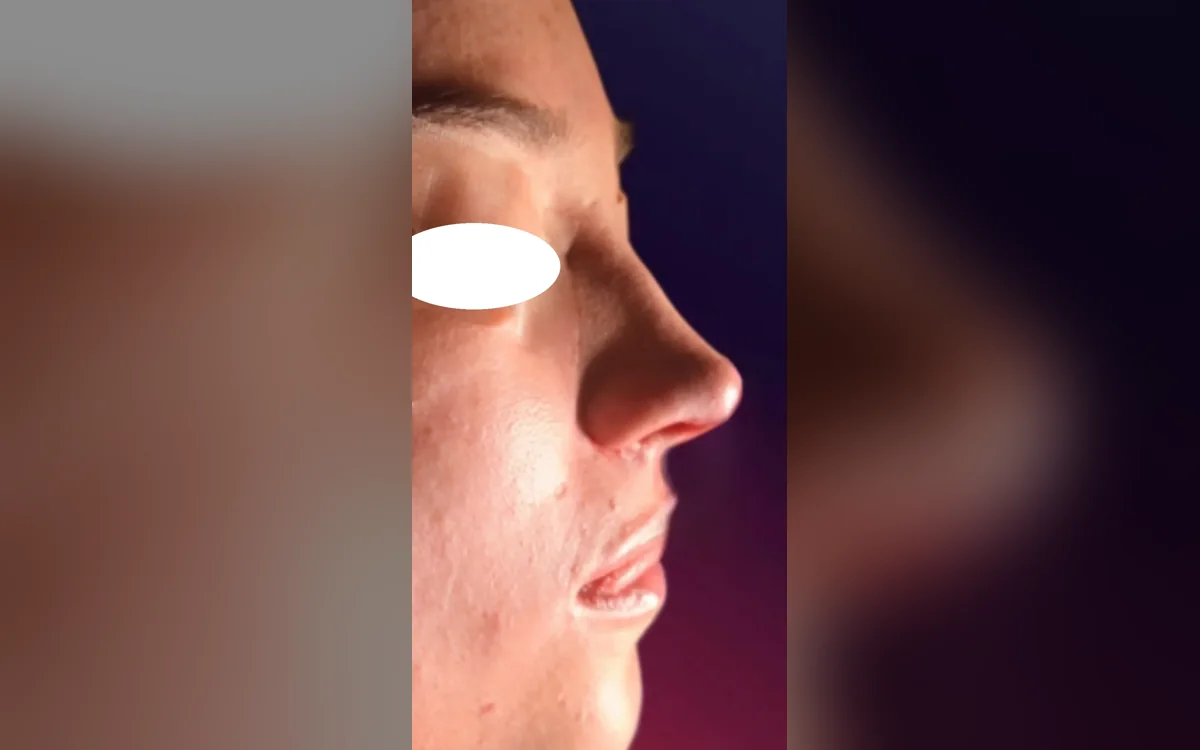 Resultado de rinoplastia